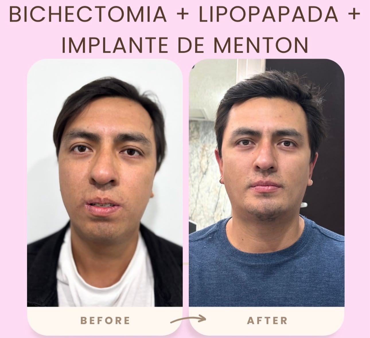 Lipopapada