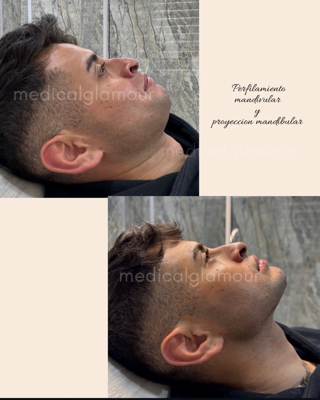 Perfilado Mandibular