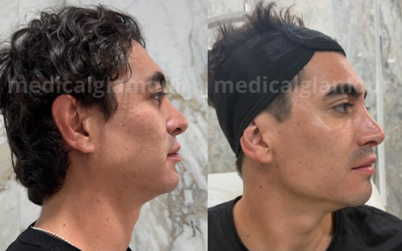 Perfilado Mandibular
